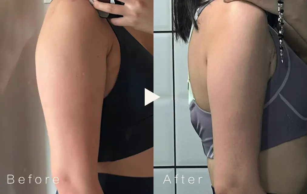 Glowism個案前後對比圖（採用混合式身型管理，當中包括ONDA PLUS）