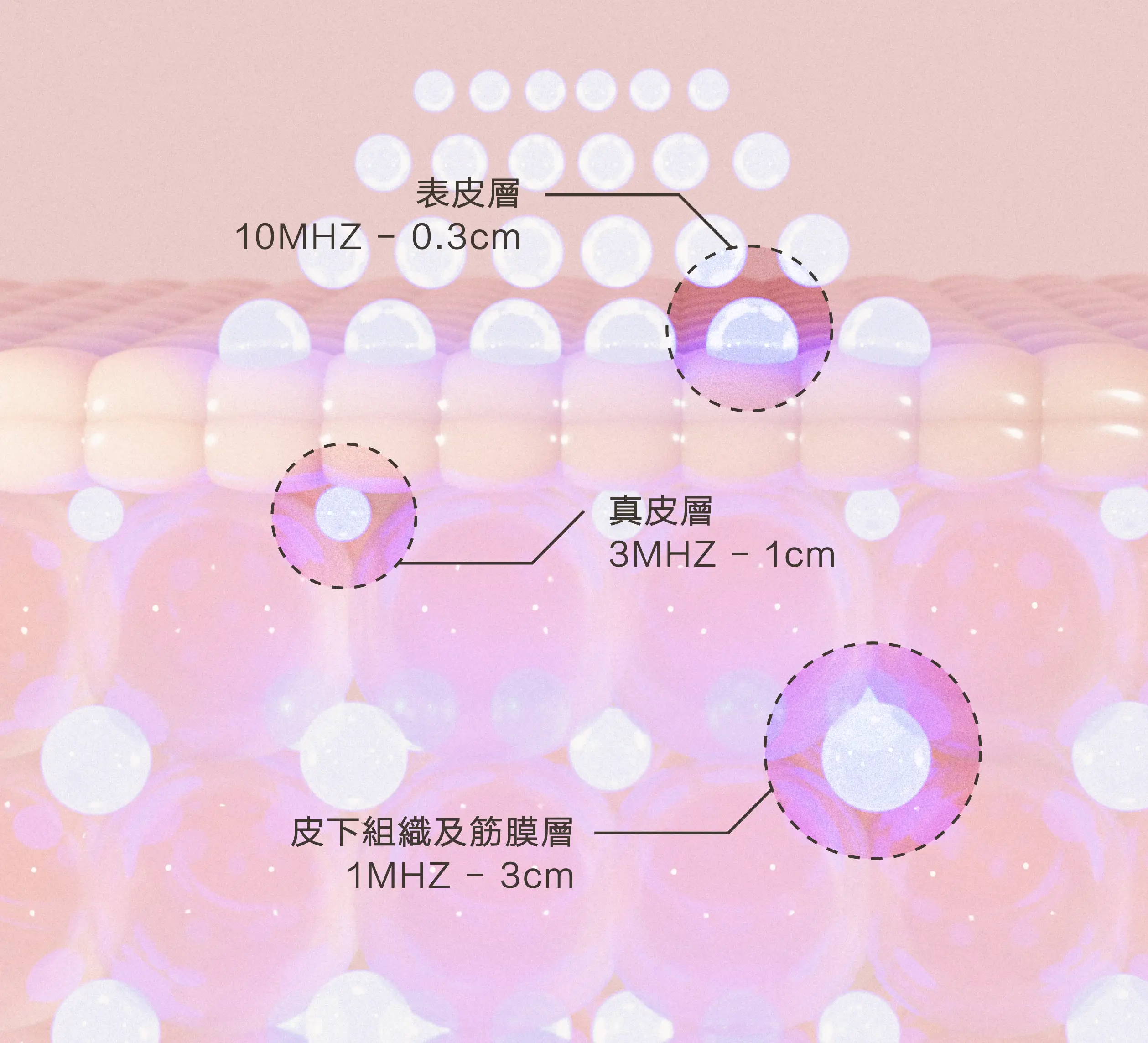 解釋德國LDM細胞機的原理。將不同頻率的高頻超聲波交替傳導至皮膚深處：10MHZ可達0.3cm至表皮層，3MHZ可達1cm至真皮層，1MHZ可達3cm至皮下組織及筋膜層。
