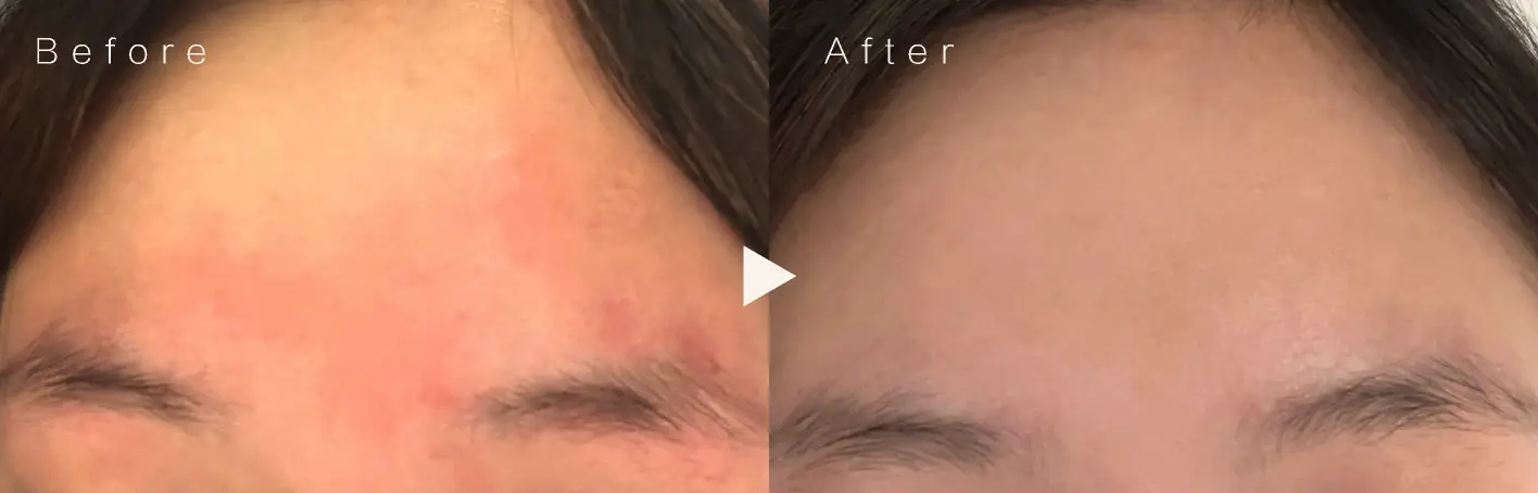 Glowism 敏感客戶個案前後對比圖