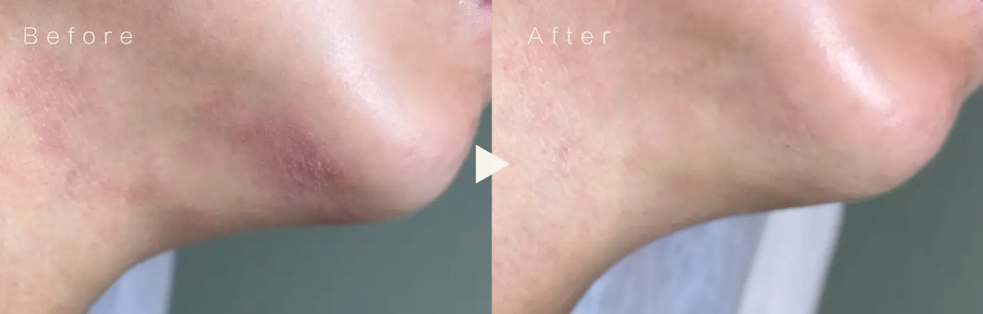 Glowism 濕疹客戶個案前後對比圖