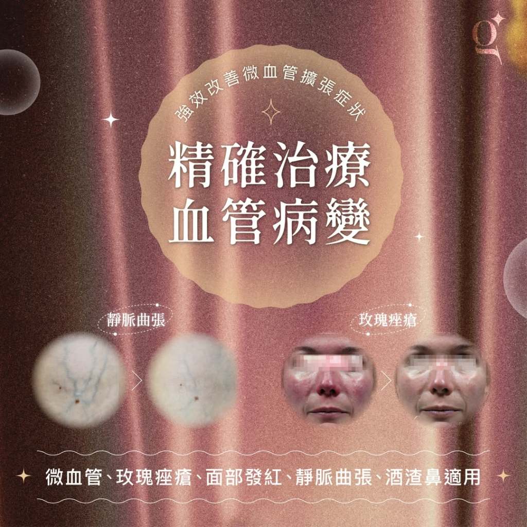 有效治療玫瑰痤瘡、微絲血管擴張（紅血絲）、酒渣鼻、靜脈曲張等血管性病灶，減少臉部泛紅與不均膚色。